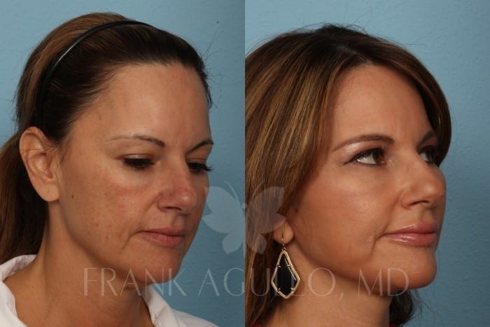 Face Lift Before and After 3