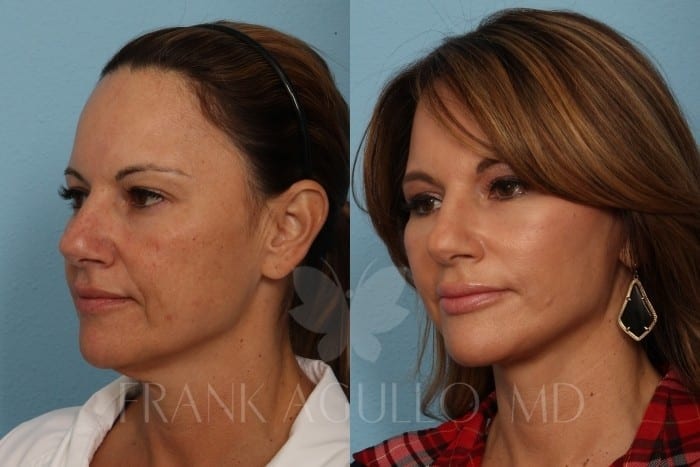 Face Lift Before and After 4