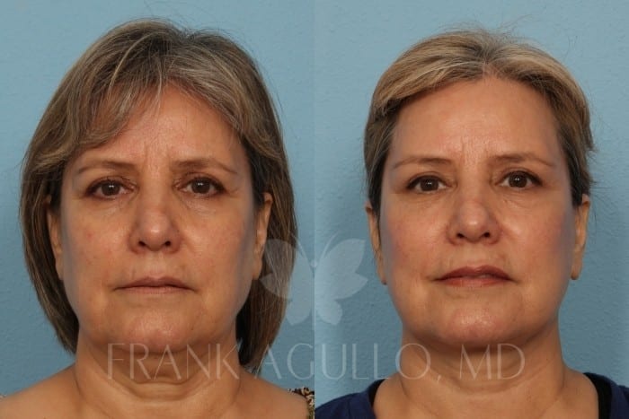 Face Lift Before and After 5