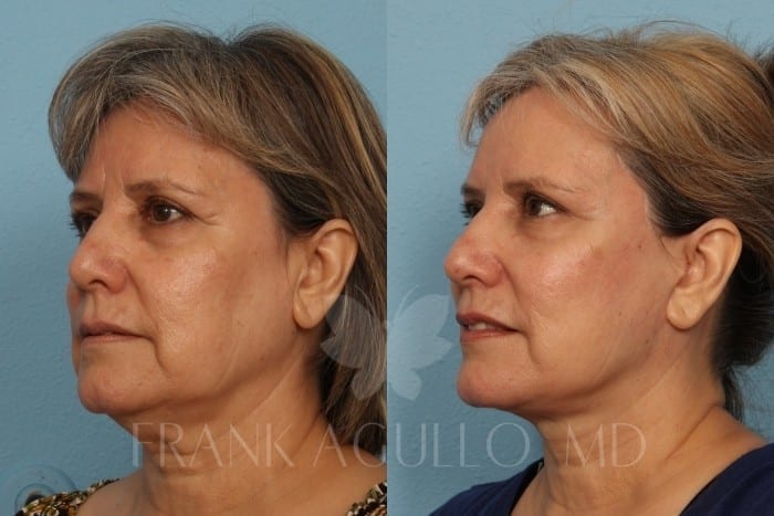 Face Lift Before and After 4