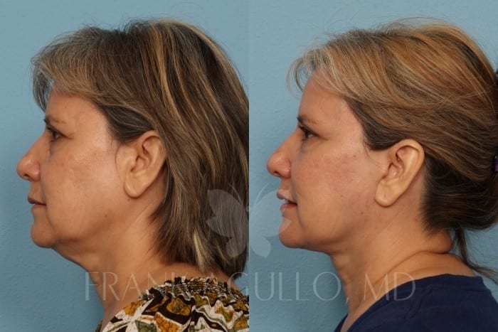 Face Lift Before and After 3