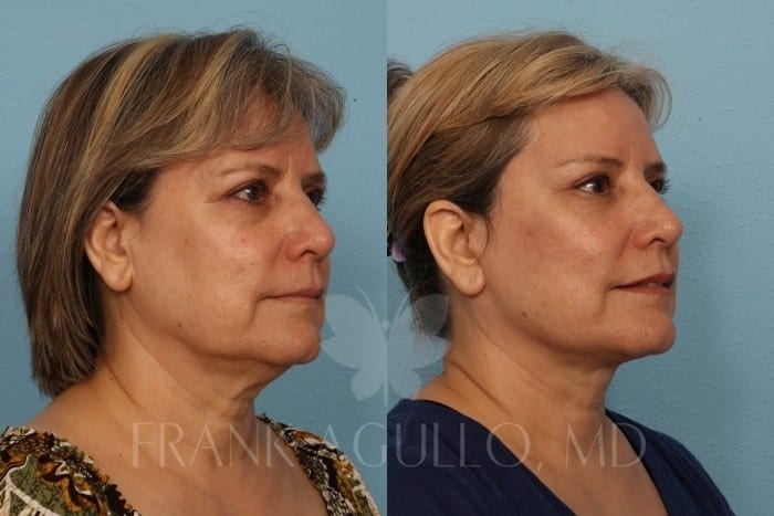 Face Lift Before and After 2
