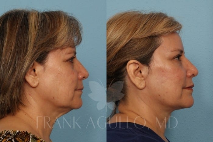 Neck Lift Before and After 3