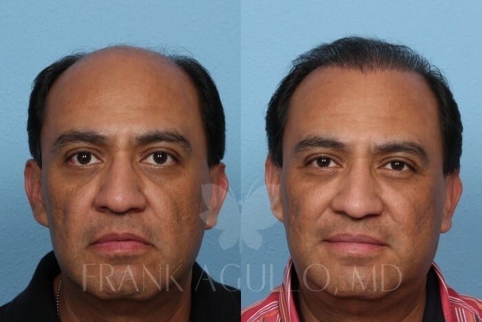 Hair Transplant Before and After 5