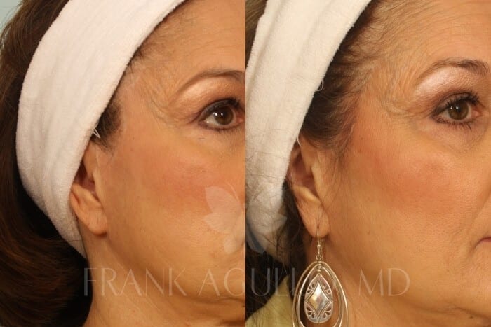 Hair Transplant Before and After 3