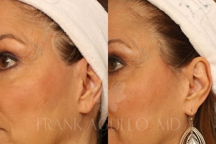 Hair Transplant Before and After 4