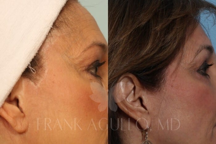 Hair Transplant Before and After 5