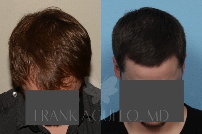 Hair Transplant Before and After 3