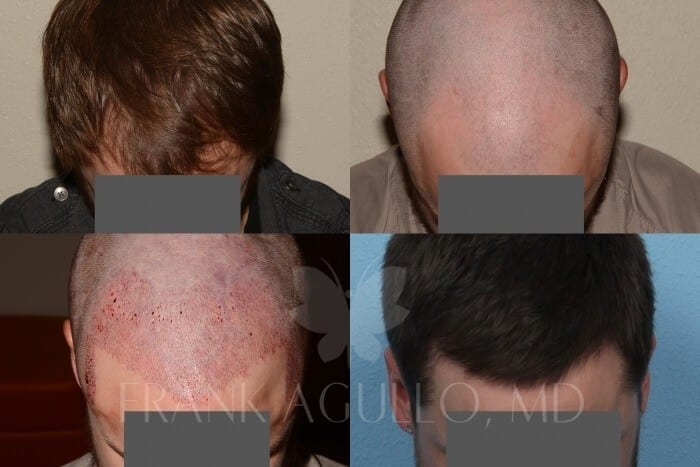 Hair Transplant Before and After 2