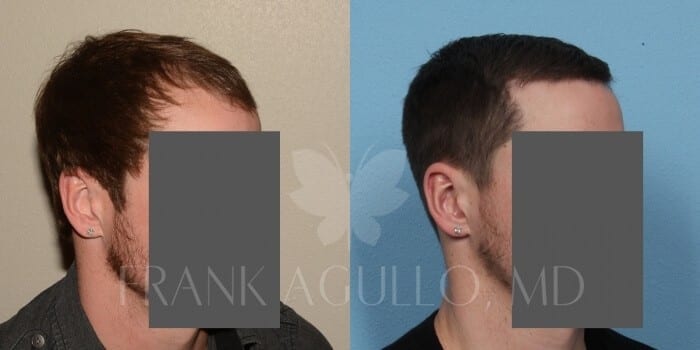 Hair Transplant Before and After 3