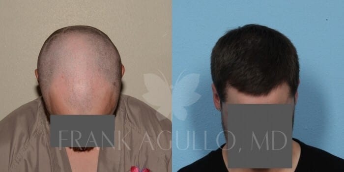 Hair Transplant Before and After 4