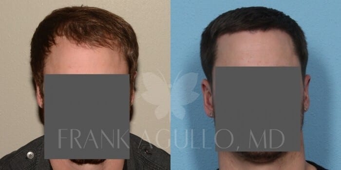 Hair Transplant Before and After 5
