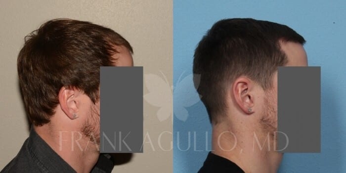 Hair Transplant Before and After 6