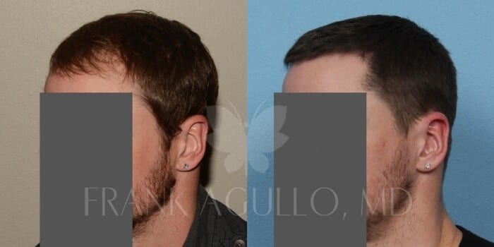 Hair Transplant Before and After 7
