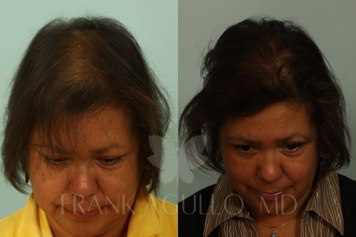 Hair Transplant Before and After 2