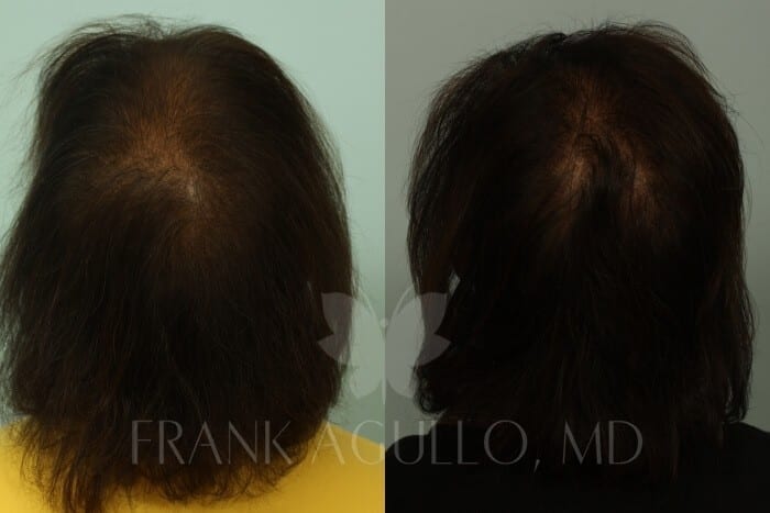 Hair Transplant Before and After 3