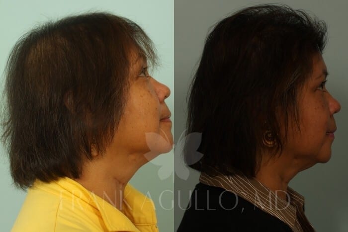 Hair Transplant Before and After 4