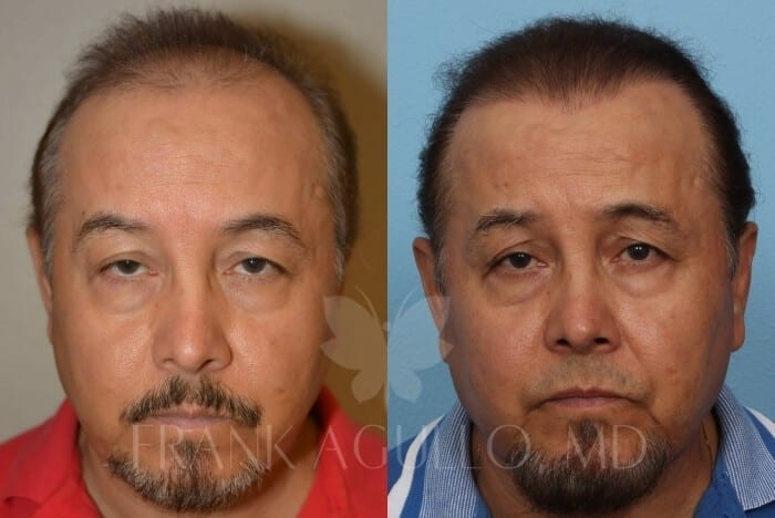 Hair Transplant for Men Before and After