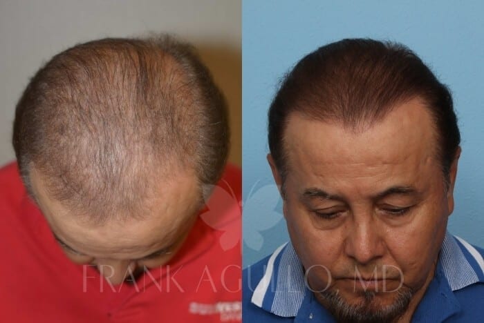 Hair Transplant Before and After 2