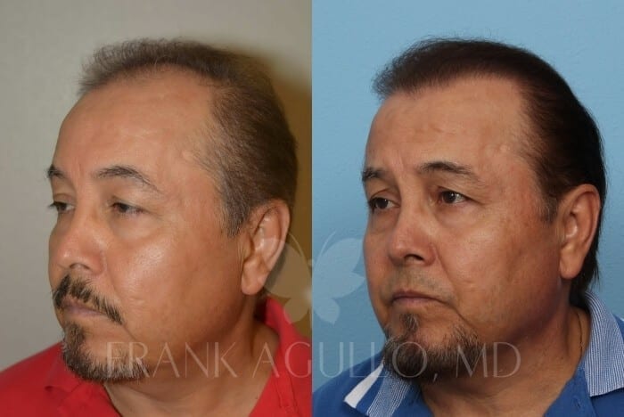 Hair Transplant Before and After 3