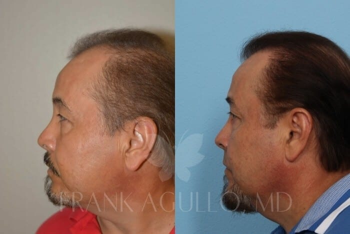 Hair Transplant Before and After 4