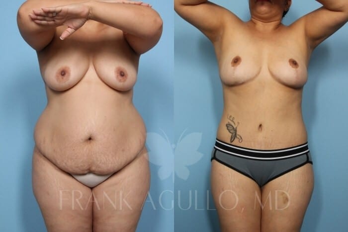 Tummy Tuck Before and After 11