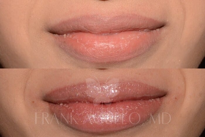Lip Augmentation Before and After 4