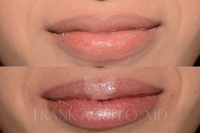 Lip Augmentation Before and After 4