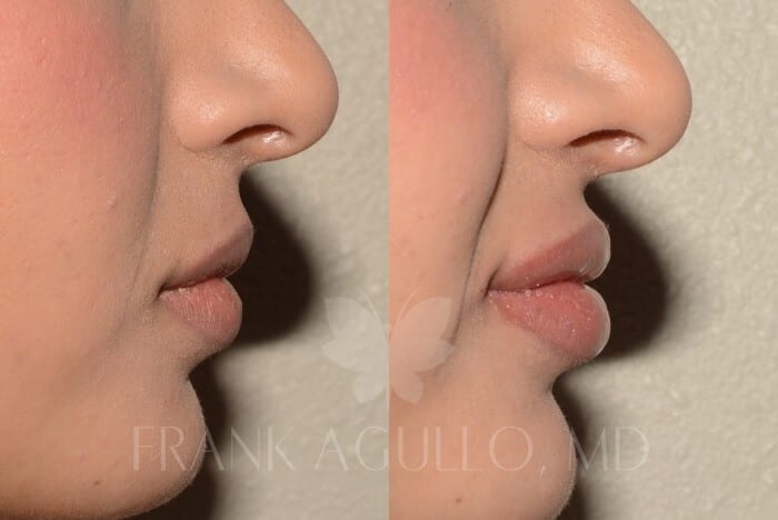 Lip Augmentation Before and After 2
