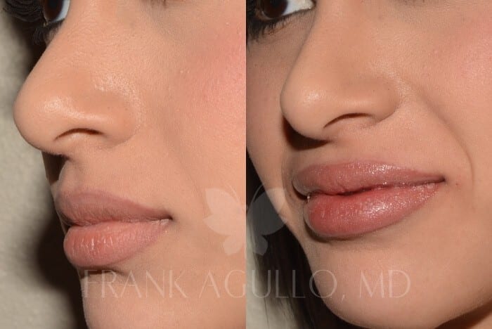 Lip Augmentation Before and After 3