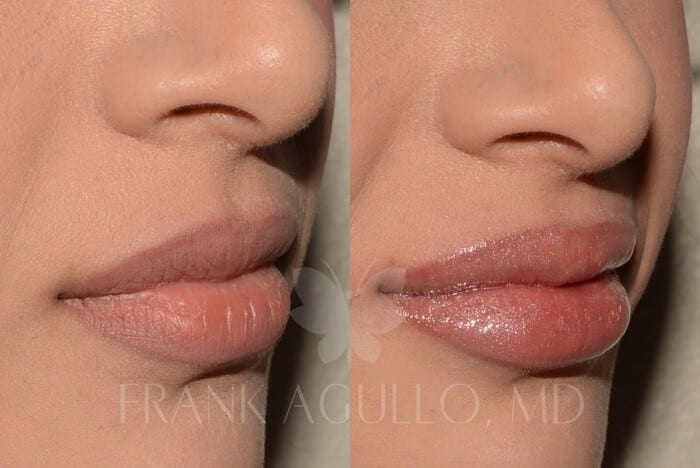 Lip Augmentation Before and After 4