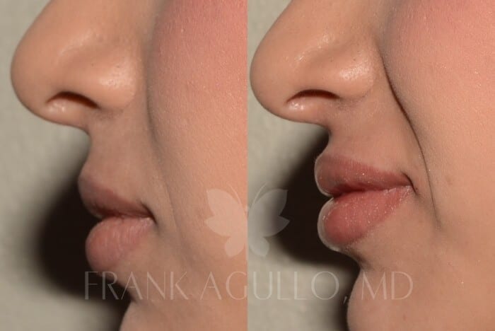 Lip Augmentation Before and After 5