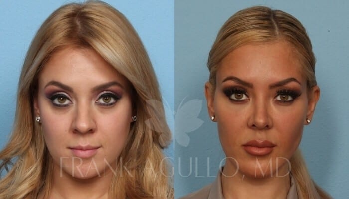 Lip Augmentation Before and After 3