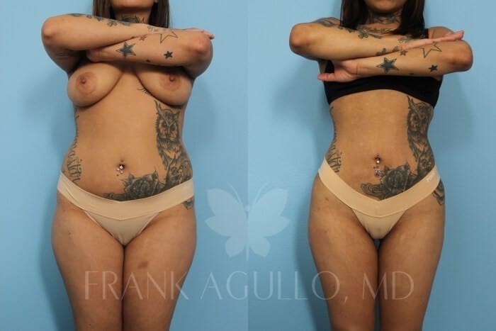 Liposuction Before and After 17