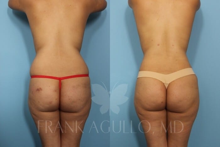 Liposuction Before and After 16