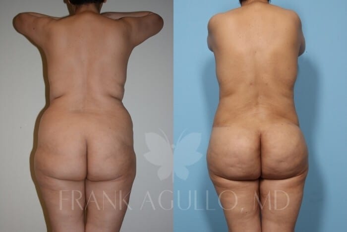 Mommy Makeover Before and After 7