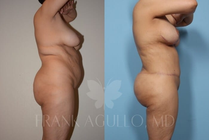 Mommy Makeover Before and After 5