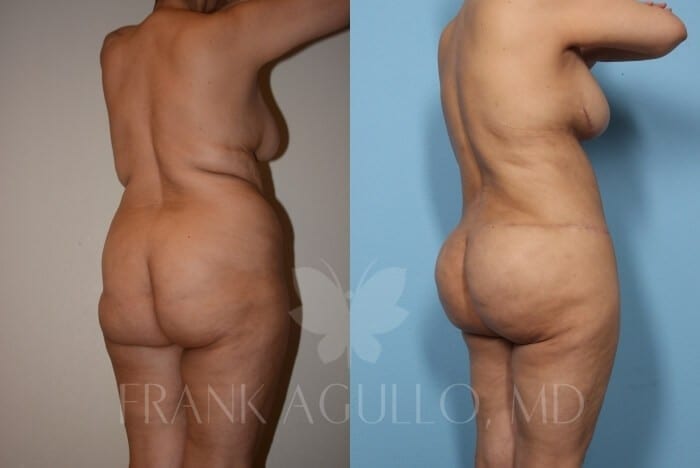 Mommy Makeover Before and After 4