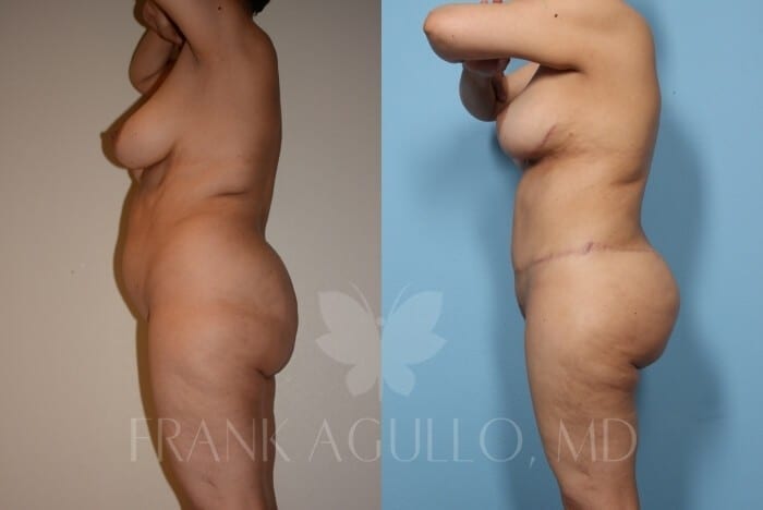 Mommy Makeover Before and After 3