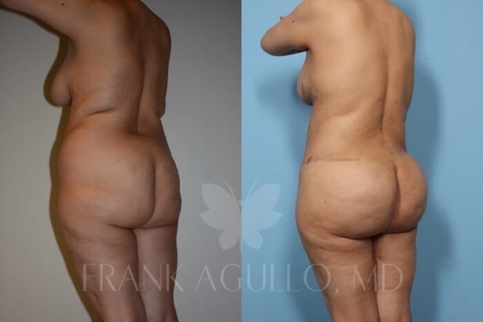 Mommy Makeover Before and After 2