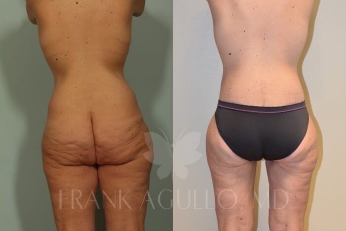 Mommy Makeover Before and After 5