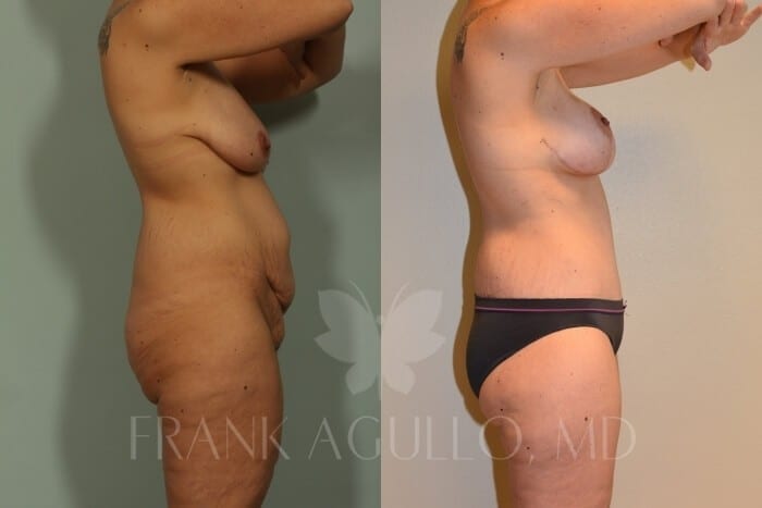 Mommy Makeover Before and After 2