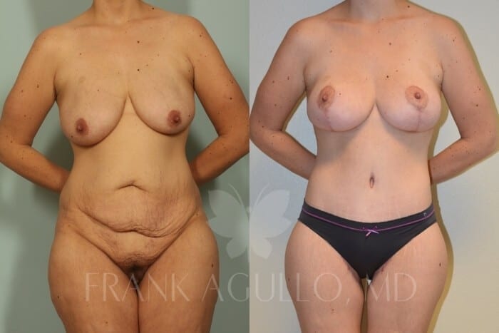 Mommy Makeover Before and After 16