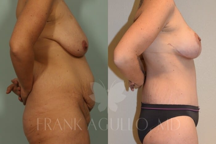Mommy Makeover Before and After 15