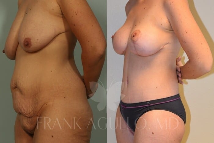 Mommy Makeover Before and After 14