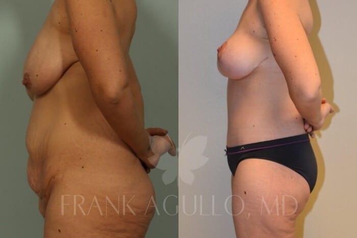 Mommy Makeover Before and After 13