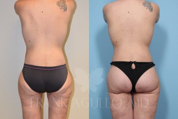 Mommy Makeover Before and After 12