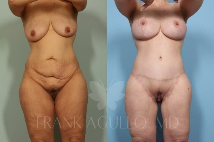 Mommy Makeover Before and After 11