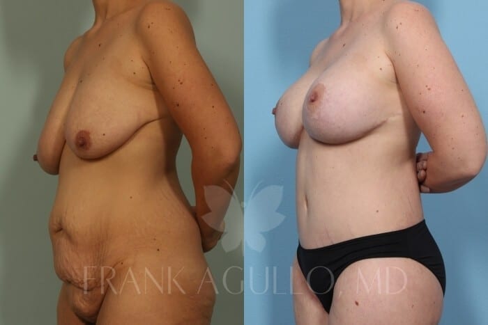 Mommy Makeover Before and After 8