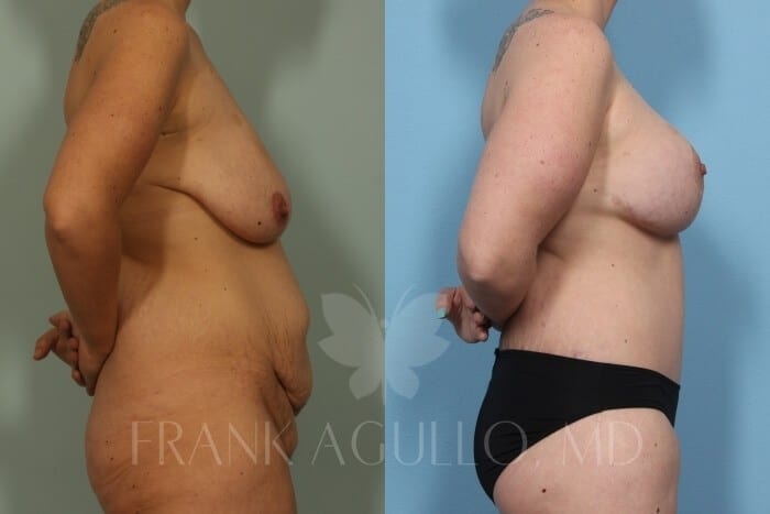 Mommy Makeover Before and After 7